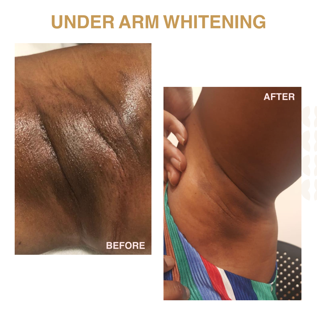 UNDER ARM 2 by sesderma