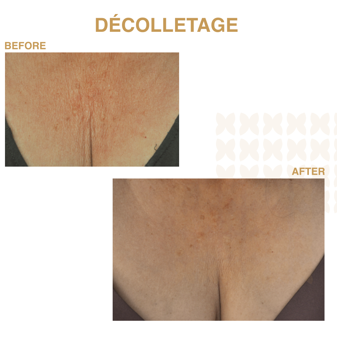 decolltage care sesderma skin centre
