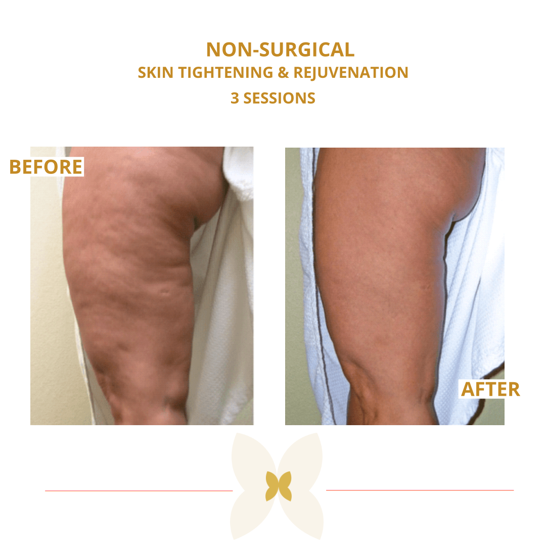 skin tightening legs