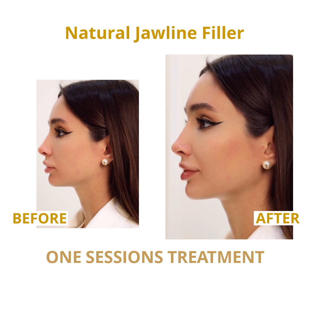 Jawline FILLER SESDERMA SKIN CENTRE