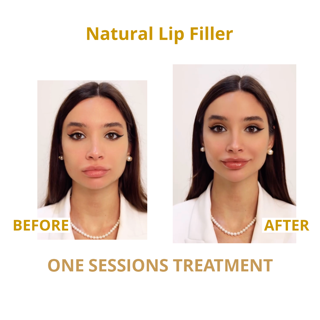 LIP FILLER SESDERMA SKIN CENTRE