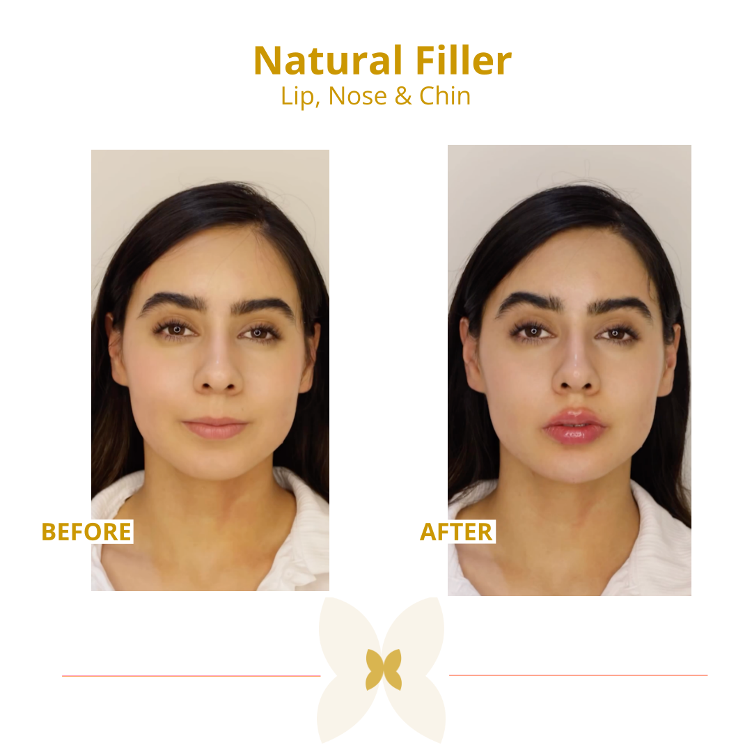filler results for sesderma skin centre Dubai